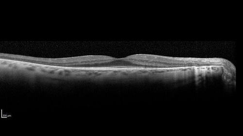 Retinitis Pigmentosa - X-linked Recessive
60 year old man The vision in the right eye is blurry recently.  He has trouble with night vision for about 3 years.  His brother has eye disease in Michigan.  
VA OD: Dcc20/32-1 PHNI NccJ1-1
VA OS: Dcc20/20 NccJ1+-1
IOP: TP: OD:36 OS:18 
He has pseudoexfoliative glaucoma in the right eye.
