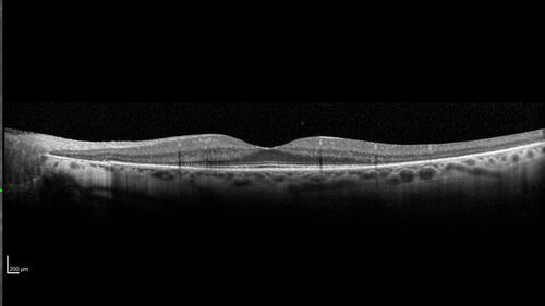Retinitis Pigmentosa - X-linked Recessive
60 year old man The vision in the right eye is blurry recently.  He has trouble with night vision for about 3 years.  His brother has eye disease in Michigan.  
VA OD: Dcc20/32-1 PHNI NccJ1-1
VA OS: Dcc20/20 NccJ1+-1
IOP: TP: OD:36 OS:18 
He has pseudoexfoliative glaucoma in the right eye.
