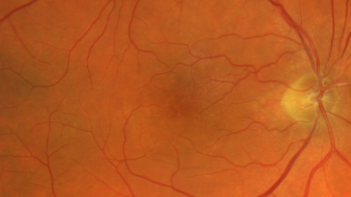 Stellate non-hereditary idiopathic foveomacular retinoschisis (SNIFR) and optic nerve drusen
84 year old man No visual complaints. Not diabetic, cataract surgery 8 years ago.  Meds: Omeprazole, Tamsulosin (Flomax)
VA 20/32 OD, 20/20 OS
