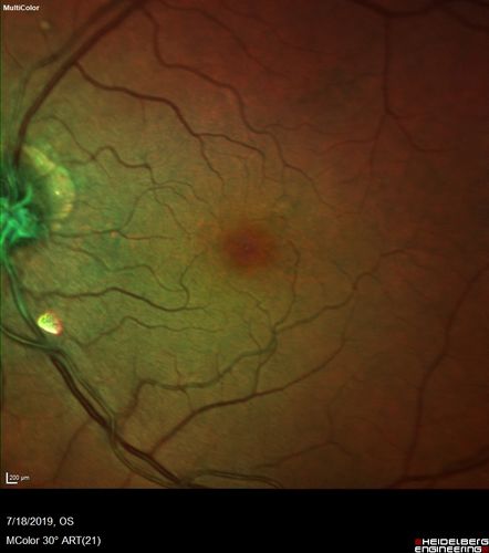 Stellate non-hereditary idiopathic foveomacular retinoschisis (SNIFR) and optic nerve drusen
84 year old man No visual complaints. Not diabetic, cataract surgery 8 years ago.  Meds: Omeprazole, Tamsulosin (Flomax)
VA 20/32 OD, 20/20 OS
