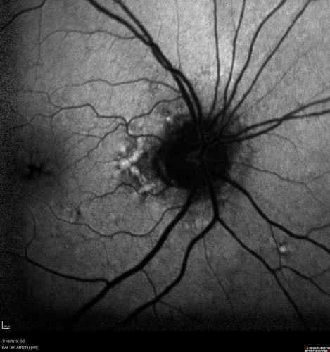 Stellate non-hereditary idiopathic foveomacular retinoschisis (SNIFR) and optic nerve drusen
84 year old man No visual complaints. Not diabetic, cataract surgery 8 years ago.  Meds: Omeprazole, Tamsulosin (Flomax)
VA 20/32 OD, 20/20 OS
