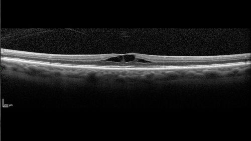 Stellate non-hereditary idiopathic foveomacular retinoschisis (SNIFR) and optic nerve drusen
84 year old man No visual complaints. Not diabetic, cataract surgery 8 years ago.  Meds: Omeprazole, Tamsulosin (Flomax)
VA 20/32 OD, 20/20 OS
