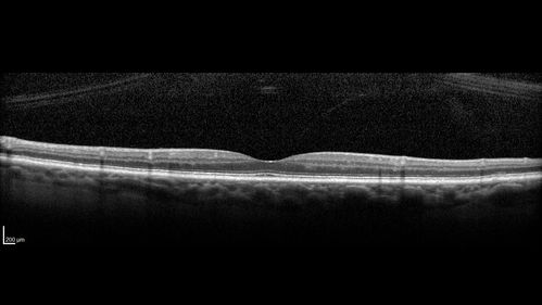 Stellate non-hereditary idiopathic foveomacular retinoschisis (SNIFR) and optic nerve drusen
84 year old man No visual complaints. Not diabetic, cataract surgery 8 years ago.  Meds: Omeprazole, Tamsulosin (Flomax)
VA 20/32 OD, 20/20 OS
