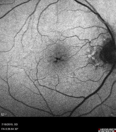 Stellate non-hereditary idiopathic foveomacular retinoschisis (SNIFR) and optic nerve drusen
84 year old man No visual complaints. Not diabetic, cataract surgery 8 years ago.  Meds: Omeprazole, Tamsulosin (Flomax)
VA 20/32 OD, 20/20 OS
