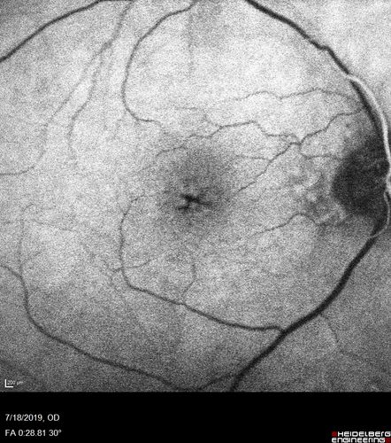 Stellate non-hereditary idiopathic foveomacular retinoschisis (SNIFR) and optic nerve drusen
84 year old man No visual complaints. Not diabetic, cataract surgery 8 years ago.  Meds: Omeprazole, Tamsulosin (Flomax)
VA 20/32 OD, 20/20 OS
