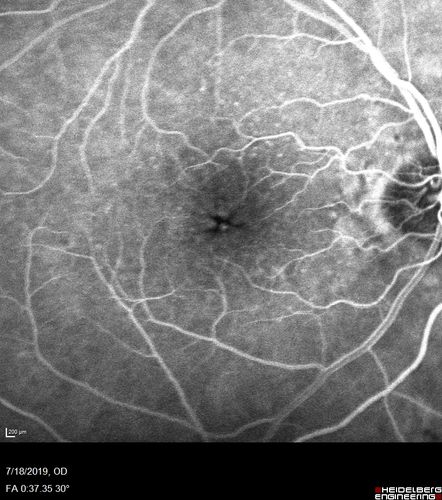 Stellate non-hereditary idiopathic foveomacular retinoschisis (SNIFR) and optic nerve drusen
84 year old man No visual complaints. Not diabetic, cataract surgery 8 years ago.  Meds: Omeprazole, Tamsulosin (Flomax)
VA 20/32 OD, 20/20 OS
