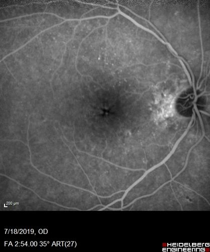 Stellate non-hereditary idiopathic foveomacular retinoschisis (SNIFR) and optic nerve drusen
84 year old man No visual complaints. Not diabetic, cataract surgery 8 years ago.  Meds: Omeprazole, Tamsulosin (Flomax)
VA 20/32 OD, 20/20 OS
