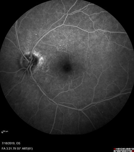 Stellate non-hereditary idiopathic foveomacular retinoschisis (SNIFR) and optic nerve drusen
84 year old man No visual complaints. Not diabetic, cataract surgery 8 years ago.  Meds: Omeprazole, Tamsulosin (Flomax)
VA 20/32 OD, 20/20 OS
