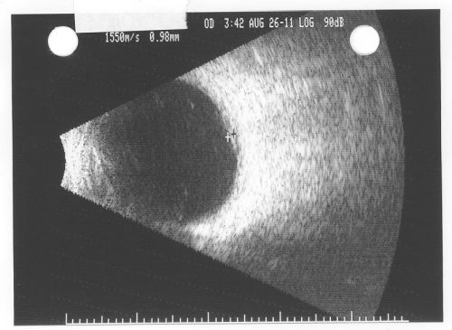 Pigmented Choroidal Mass Right Eye - Melanoma vs. Nevus vs. Unilateral Melanocytic Proliferation - Initial Visit B Scan
71-year-old man is vision has been bothering him for about a month.  He does not notice one eye particularly worse than the other.  OD is 20/40, OS is 20/25 - Initial Visit
