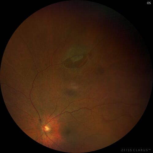 Retinal Tear before and after laser treatment
67 year old female Notices poor vision in the left eye following cataract surgery about 1 year ago.   Fluctuating floaters.  NO acute symptoms

VA 20/32 OD, 20/25 OS
