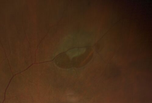 Retinal Tear before and after laser treatment
67 year old female Notices poor vision in the left eye following cataract surgery about 1 year ago.   Fluctuating floaters.  NO acute symptoms

VA 20/32 OD, 20/25 OS
