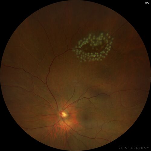 Retinal Tear before and after laser treatment
67 year old female Notices poor vision in the left eye following cataract surgery about 1 year ago.   Fluctuating floaters.  NO acute symptoms

VA 20/32 OD, 20/25 OS
