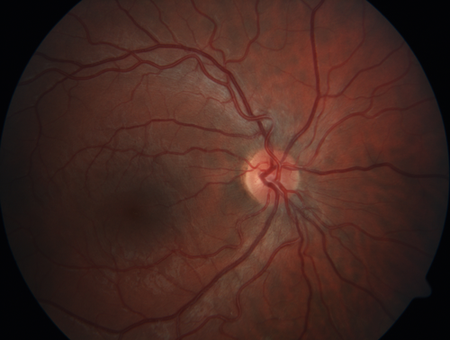 Torpedo Maculopathy - Left Eye
25 year old man with normal vision.  Left macula has torpedo lesion
