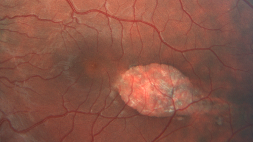 Torpedo Maculopathy - Left Eye
25 year old man with normal vision.  Left macula has torpedo lesion
