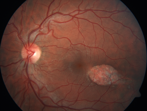 Torpedo Maculopathy - Left Eye
25 year old man with normal vision.  Left macula has torpedo lesion
