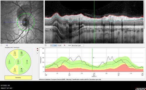 Traumatic Peripapillary Subretinal Hemorrhage
16 year old hit in eye with finger during basketball.  Vision is 20/25 and there is a peripapillary hemorrhage.
