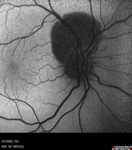 Traumatic Peripapillary Subretinal Hemorrhage
16 year old hit in eye with finger during basketball.  Vision is 20/25 and there is a peripapillary hemorrhage.
