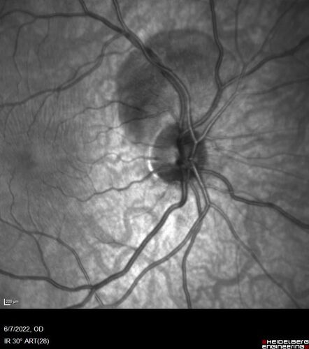 Traumatic Peripapillary Subretinal Hemorrhage
16 year old hit in eye with finger during basketball.  Vision is 20/25 and there is a peripapillary hemorrhage.
