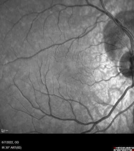 Traumatic Peripapillary Subretinal Hemorrhage
16 year old hit in eye with finger during basketball.  Vision is 20/25 and there is a peripapillary hemorrhage.
