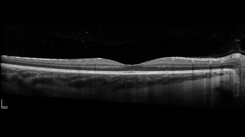 Traumatic Peripapillary Subretinal Hemorrhage
16 year old hit in eye with finger during basketball.  Vision is 20/25 and there is a peripapillary hemorrhage.

