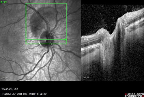 Traumatic Peripapillary Subretinal Hemorrhage
16 year old hit in eye with finger during basketball.  Vision is 20/25 and there is a peripapillary hemorrhage.
