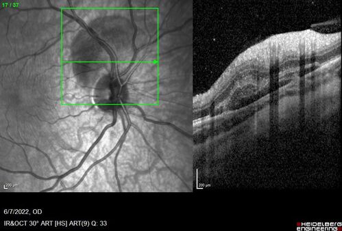Traumatic Peripapillary Subretinal Hemorrhage
16 year old hit in eye with finger during basketball.  Vision is 20/25 and there is a peripapillary hemorrhage.
