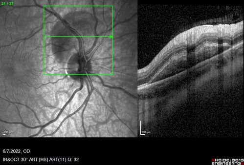 Traumatic Peripapillary Subretinal Hemorrhage
16 year old hit in eye with finger during basketball.  Vision is 20/25 and there is a peripapillary hemorrhage.
