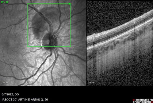 Traumatic Peripapillary Subretinal Hemorrhage
16 year old hit in eye with finger during basketball.  Vision is 20/25 and there is a peripapillary hemorrhage.
