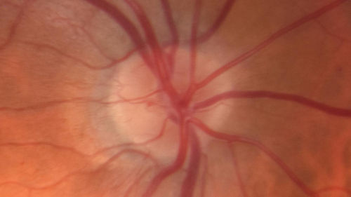 Vitreous Hemorrhage with no evidence of PDR in the left eye
74 year old man with vision loss OS for about a week.  The FA shows no PDR in the left eye but the right eye has very mild NVD. Diabetes for 40 years now on insulin.
