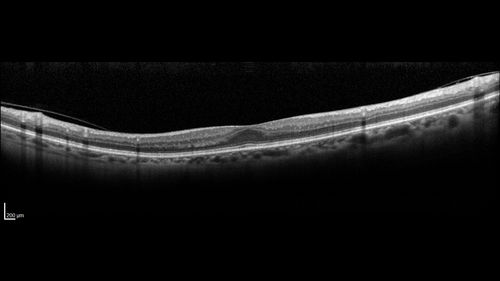 Vitreous Hemorrhage with no evidence of PDR in the left eye
74 year old man with vision loss OS for about a week.  The FA shows no PDR in the left eye but the right eye has very mild NVD. Diabetes for 40 years now on insulin.
