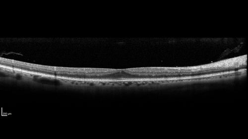 Vitreous Hemorrhage with no evidence of PDR in the left eye
74 year old man with vision loss OS for about a week.  The FA shows no PDR in the left eye but the right eye has very mild NVD. Diabetes for 40 years now on insulin.

