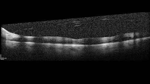 Vitreous Hemorrhage with no evidence of PDR in the left eye
74 year old man with vision loss OS for about a week.  The FA shows no PDR in the left eye but the right eye has very mild NVD. Diabetes for 40 years now on insulin.
