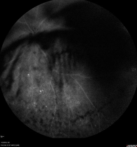 Vitreous Hemorrhage with no evidence of PDR in the left eye
74 year old man with vision loss OS for about a week.  The FA shows no PDR in the left eye but the right eye has very mild NVD. Diabetes for 40 years now on insulin.
