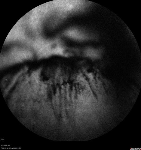 Vitreous Hemorrhage with no evidence of PDR in the left eye
74 year old man with vision loss OS for about a week.  The FA shows no PDR in the left eye but the right eye has very mild NVD. Diabetes for 40 years now on insulin.

