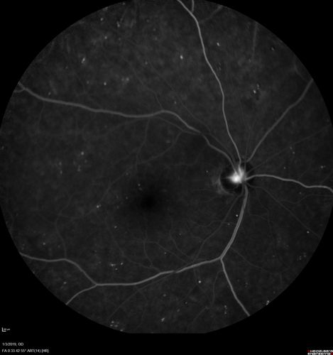 Vitreous Hemorrhage with no evidence of PDR in the left eye
74 year old man with vision loss OS for about a week.  The FA shows no PDR in the left eye but the right eye has very mild NVD. Diabetes for 40 years now on insulin.
