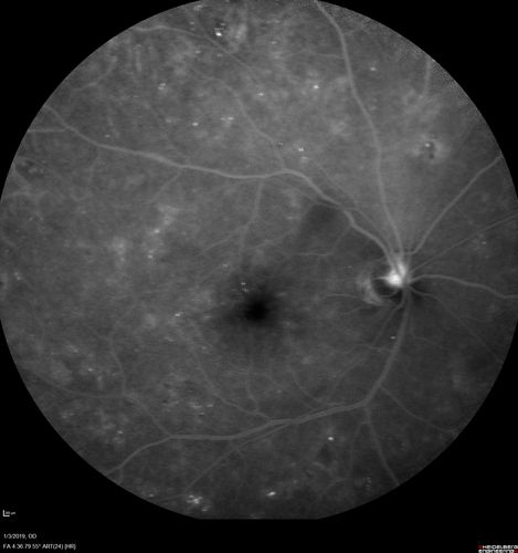 Vitreous Hemorrhage with no evidence of PDR in the left eye
74 year old man with vision loss OS for about a week.  The FA shows no PDR in the left eye but the right eye has very mild NVD. Diabetes for 40 years now on insulin.

