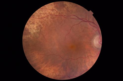 Macular Hole - Asymptomatic
71 year old female did not notice 20/200 macular hole. Post surgery vision improved to 20/30
