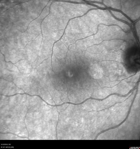 Macular Hole - Asymptomatic
71 year old female did not notice 20/200 macular hole. Post surgery vision improved to 20/30
