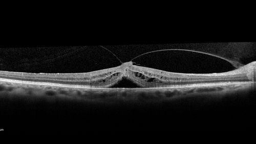 Macular Hole - Asymptomatic
71 year old female did not notice 20/200 macular hole. Post surgery vision improved to 20/30
