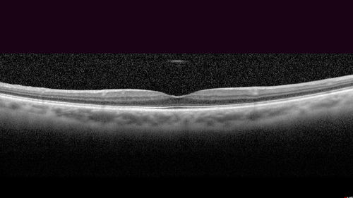 Macular Hole - Asymptomatic
71 year old female did not notice 20/200 macular hole. Post surgery vision improved to 20/30
