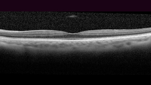 Macular Hole - Asymptomatic
71 year old female did not notice 20/200 macular hole. Post surgery vision improved to 20/30
