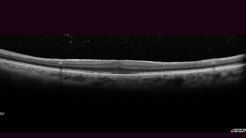 Macular Hole - Asymptomatic
71 year old female did not notice 20/200 macular hole. Post surgery vision improved to 20/30
