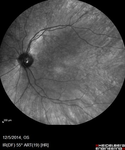 Vitreomacular traction - 20/50 vision and symptomatic with metamorphopsia
