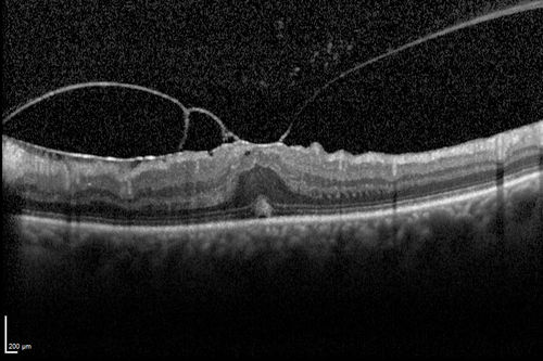 Vitreomacular traction - 20/40 vision and symptomatic with metamorphopsia
