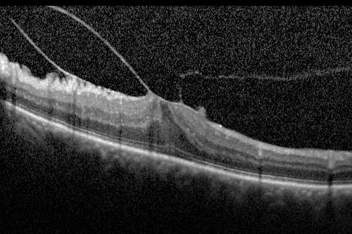 Vitreomacular traction - 20/50 vision and symptomatic with metamorphopsia
