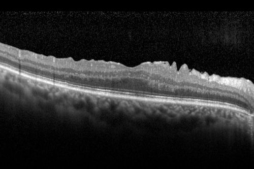 Vitreomacular traction - 20/25 vision 6 months post- vitrectomy
