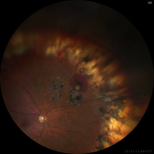 Vasoproliferative Tumor 7 Years after Retinal Detachment Repair
65 year old female presents 7 years following retinal detachment repair with peripheral white mass with hemorrhage.
