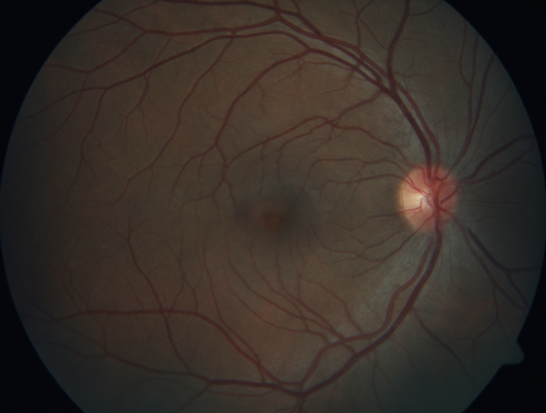 White Retinal Artiole Left eye - Inferotemporal
31 year old female with migraines and headaches for the last 12-13 years.  Sometimes she gets the visual symptoms with the migraine.  When she gets the migraines the pain is on the left side of her head.  She gets the problem a few times a month, sometimes more.  They usually last 5-6  hours. She has not had a permanent vision change.  When she gets a vision change there are spotty dots of blue neon lights in her vision.  With her glasses her two eyes are about the same.  VA 20/16 in Each Eye
