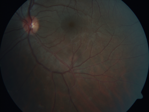 White Retinal Artiole Left eye - Inferotemporal
31 year old female with migraines and headaches for the last 12-13 years.  Sometimes she gets the visual symptoms with the migraine.  When she gets the migraines the pain is on the left side of her head.  She gets the problem a few times a month, sometimes more.  They usually last 5-6  hours. She has not had a permanent vision change.  When she gets a vision change there are spotty dots of blue neon lights in her vision.  With her glasses her two eyes are about the same.  VA 20/16 in Each Eye
