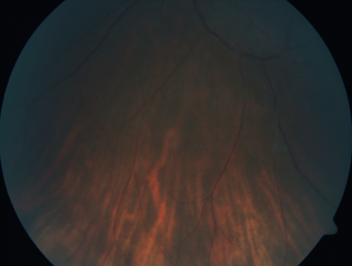 White Retinal Artiole Left eye - Inferotemporal
31 year old female with migraines and headaches for the last 12-13 years.  Sometimes she gets the visual symptoms with the migraine.  When she gets the migraines the pain is on the left side of her head.  She gets the problem a few times a month, sometimes more.  They usually last 5-6  hours. She has not had a permanent vision change.  When she gets a vision change there are spotty dots of blue neon lights in her vision.  With her glasses her two eyes are about the same.  VA 20/16 in Each Eye
